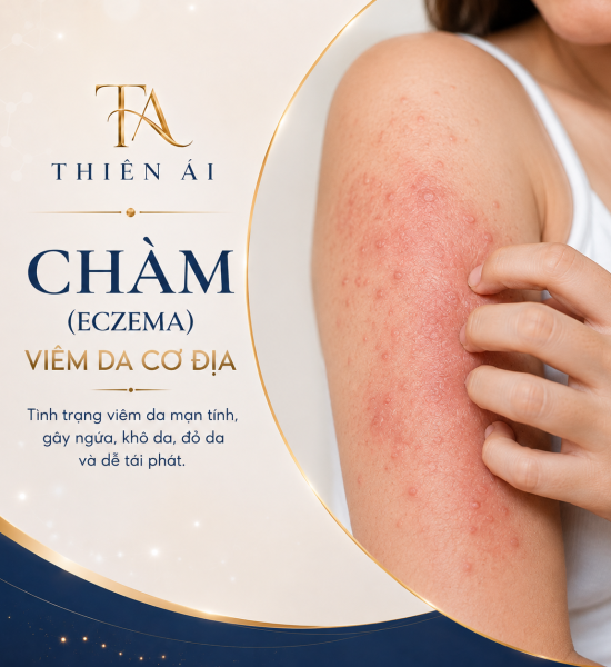 Chàm (Eczema), viêm da cơ địa