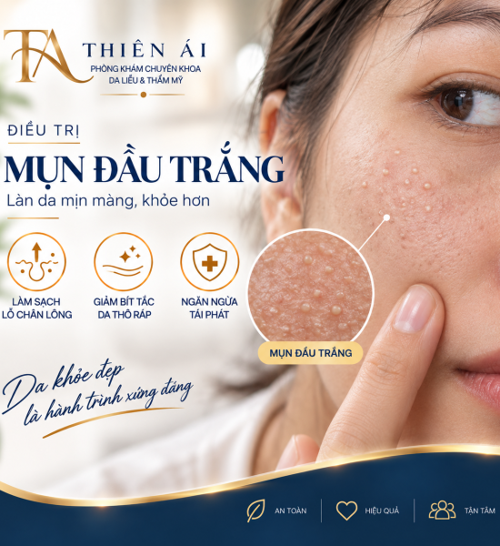 Mụn đầu trắng