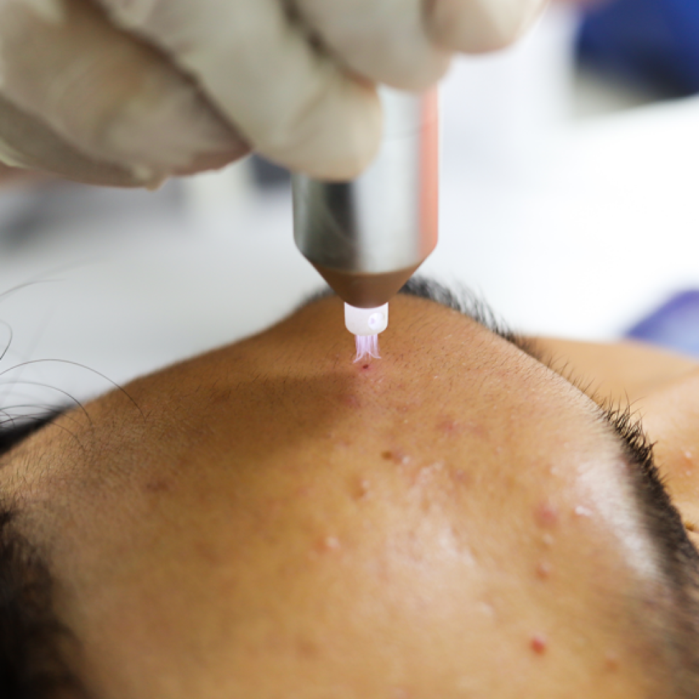Điều trị bằng Plasma