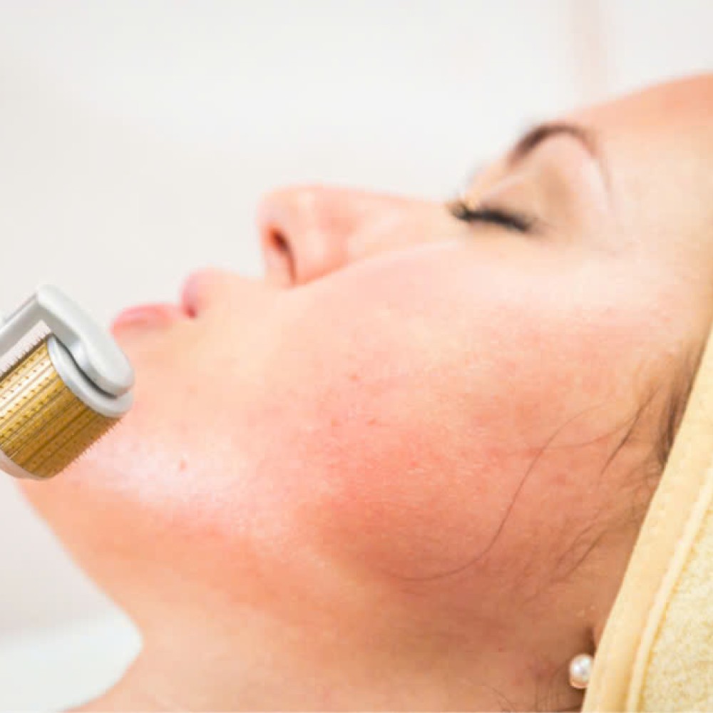 Điều trị mụn và sẹo