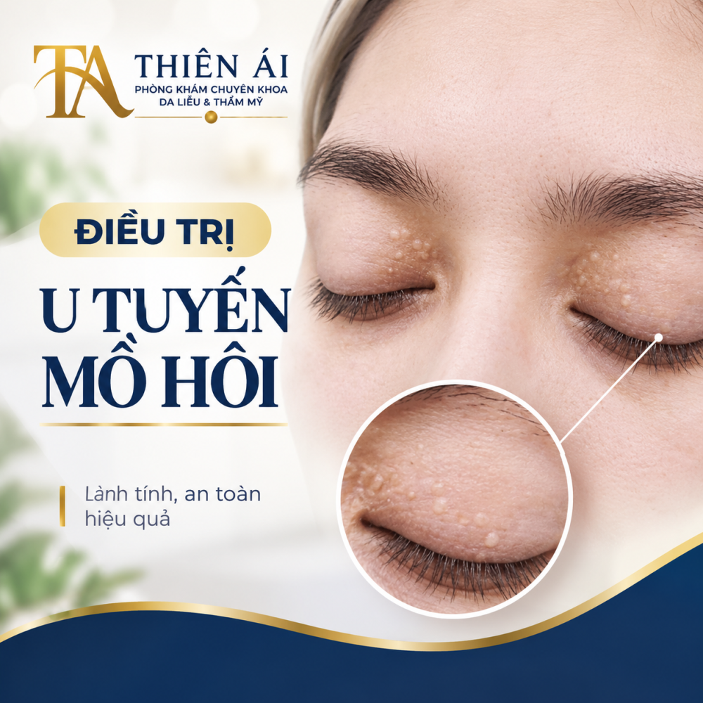 Điều trị u tuyến mồ hôi