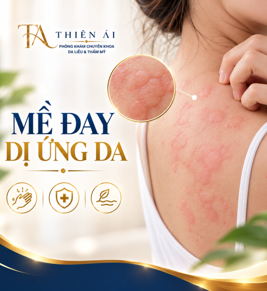 Mề đay, dị ứng da