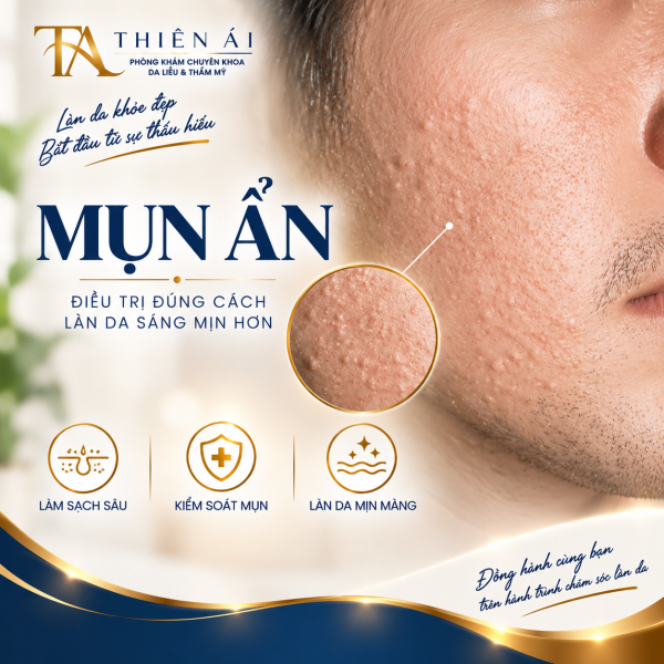 Mụn ẩn Mụn ẩn