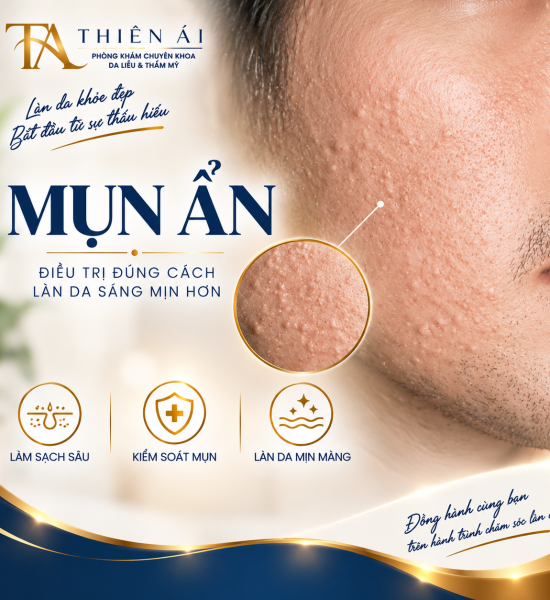 Mụn ẩn