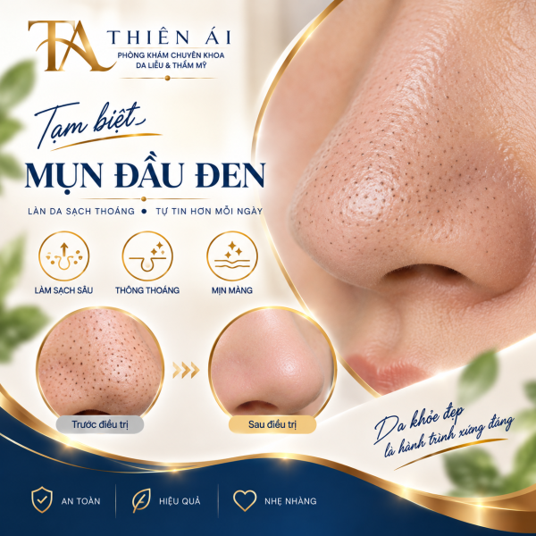 Mụn đầu đen Mụn đầu đen