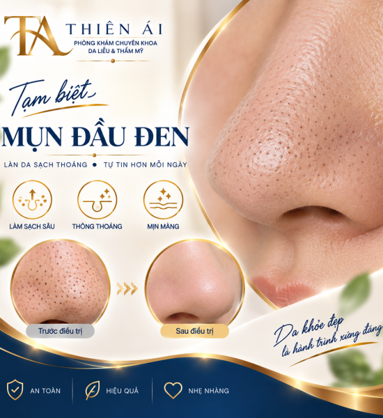 Mụn đầu đen