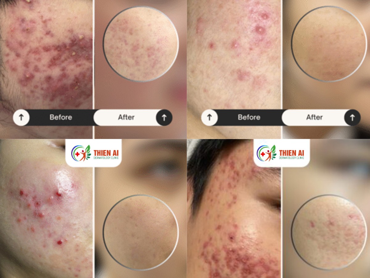 Điều trị mụn tại Phòng Khám Chuyên Khoa Da Liễu Thiên Ái