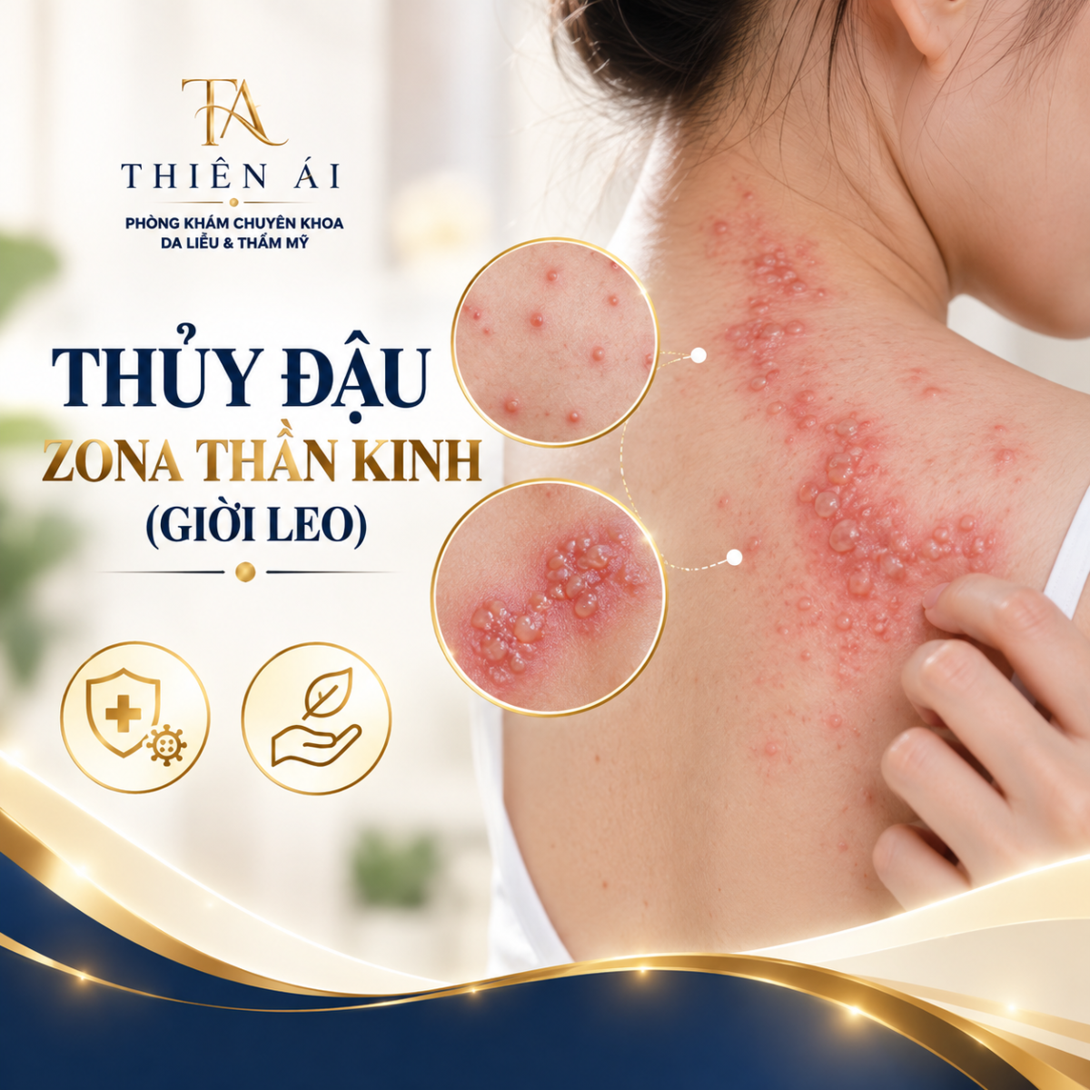 Thủy đậu, zona thần kinh (giời leo)