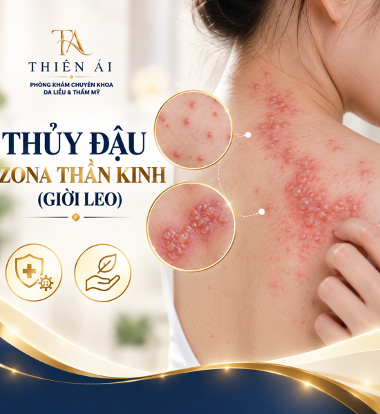 Thủy đậu, zona thần kinh (giời leo)