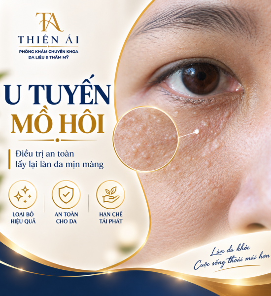 U tuyến mồ hôi