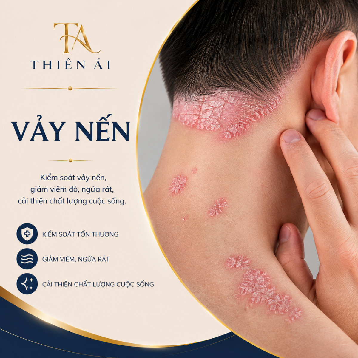 Vảy nến