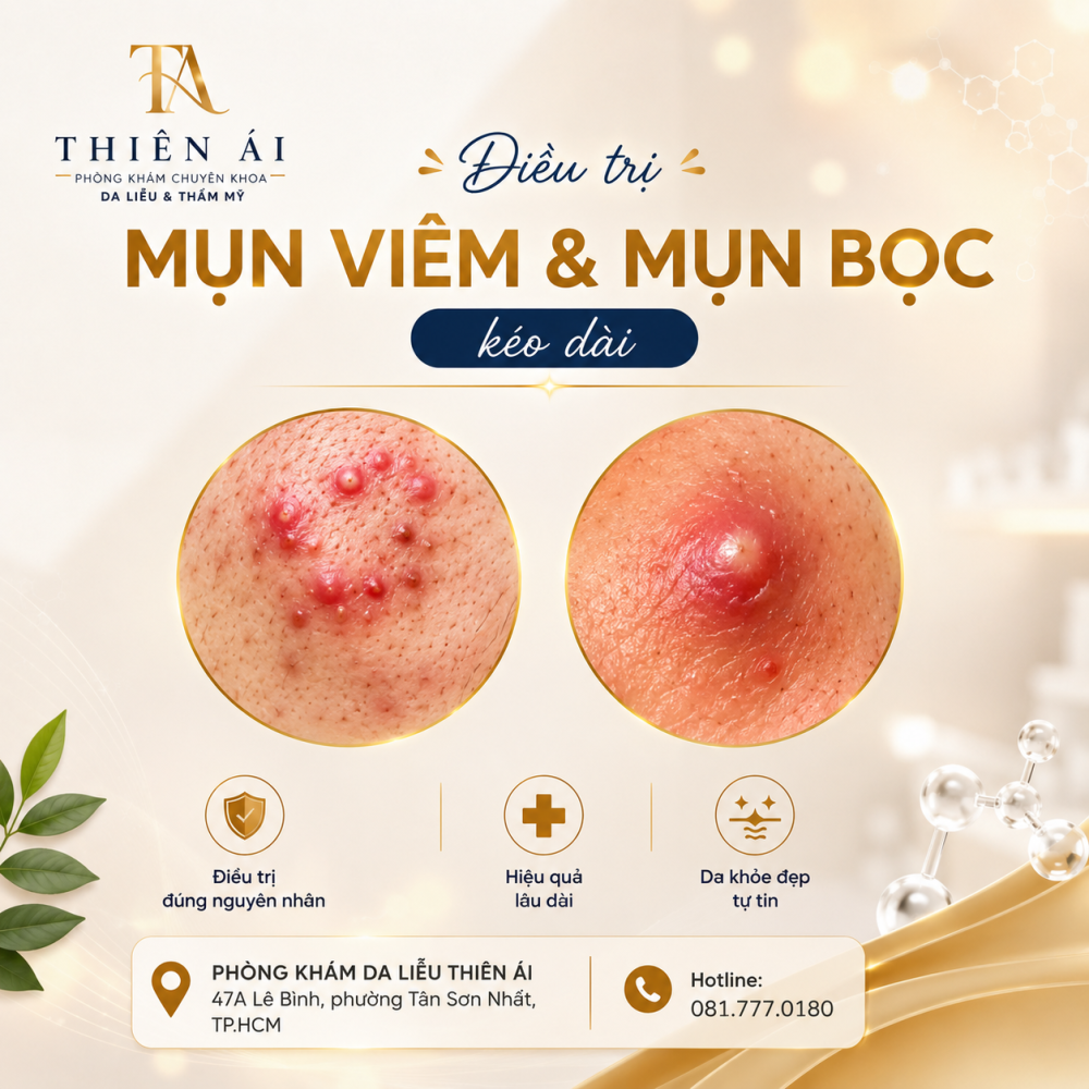 Điều trị mụn viêm và mụn bọc kéo dài dưới sự theo dõi của bác sĩ da liễu Diệu My