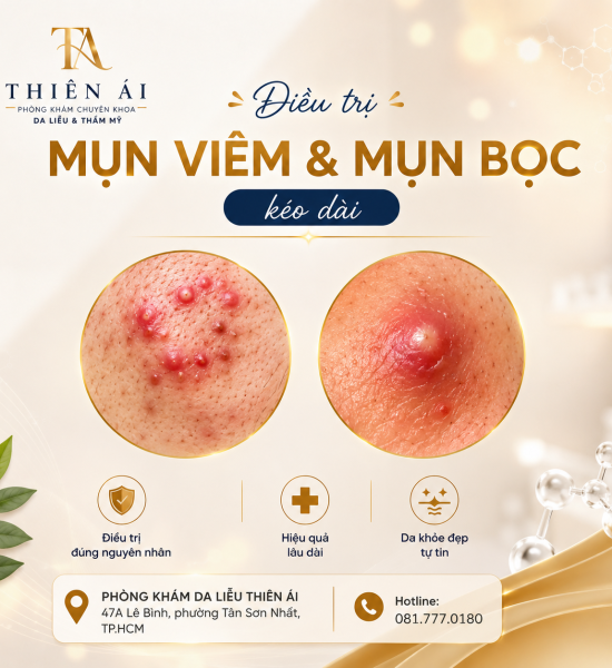 Điều trị mụn viêm và mụn bọc kéo dài dưới sự theo dõi của bác sĩ da liễu Diệu My