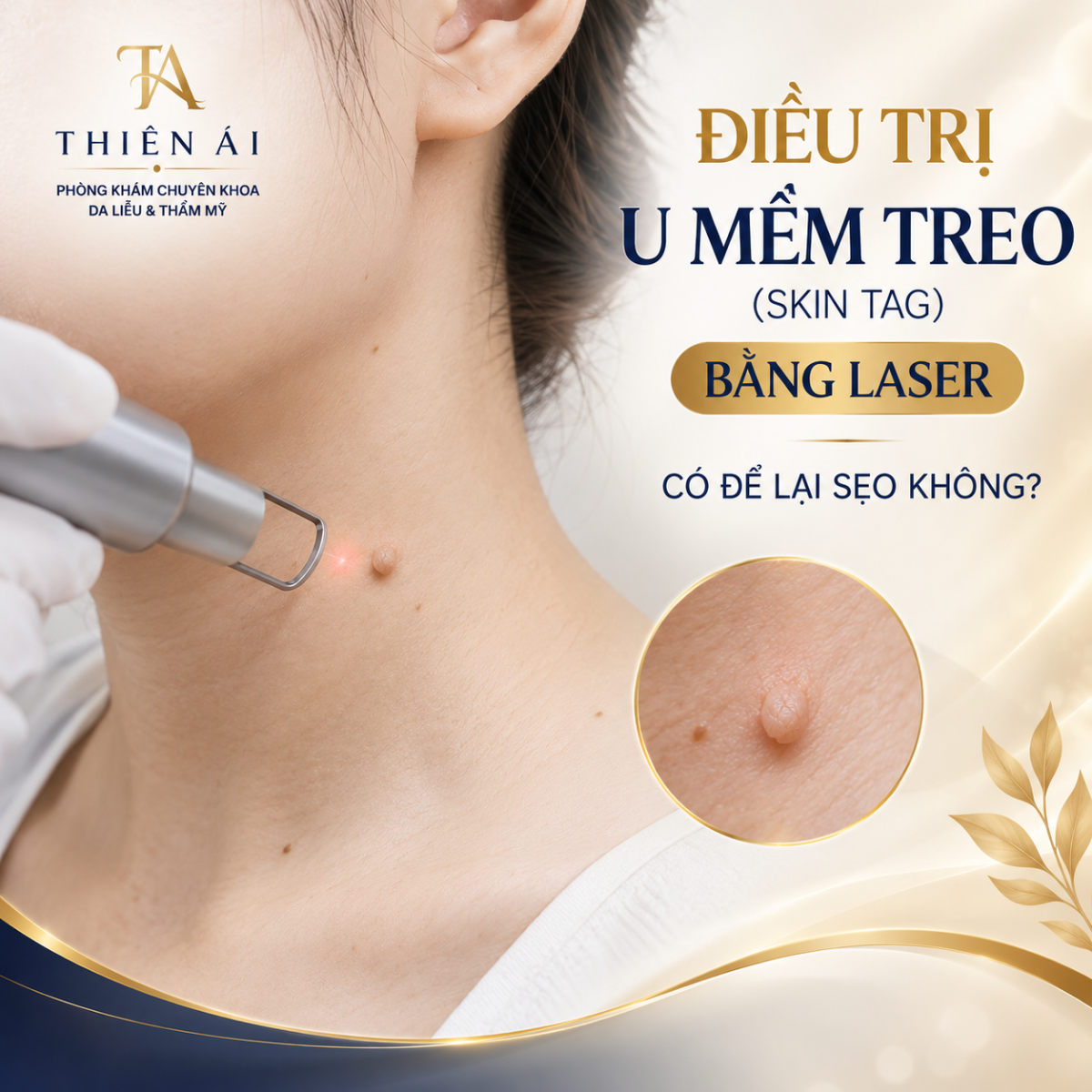 Điều trị u mềm treo (Skin Tag) bằng Laser có để lại sẹo không?