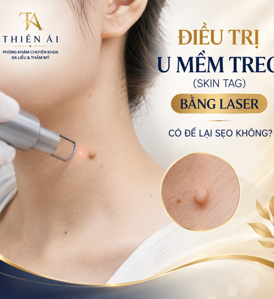 Điều trị u mềm treo (Skin Tag) bằng Laser có để lại sẹo không?