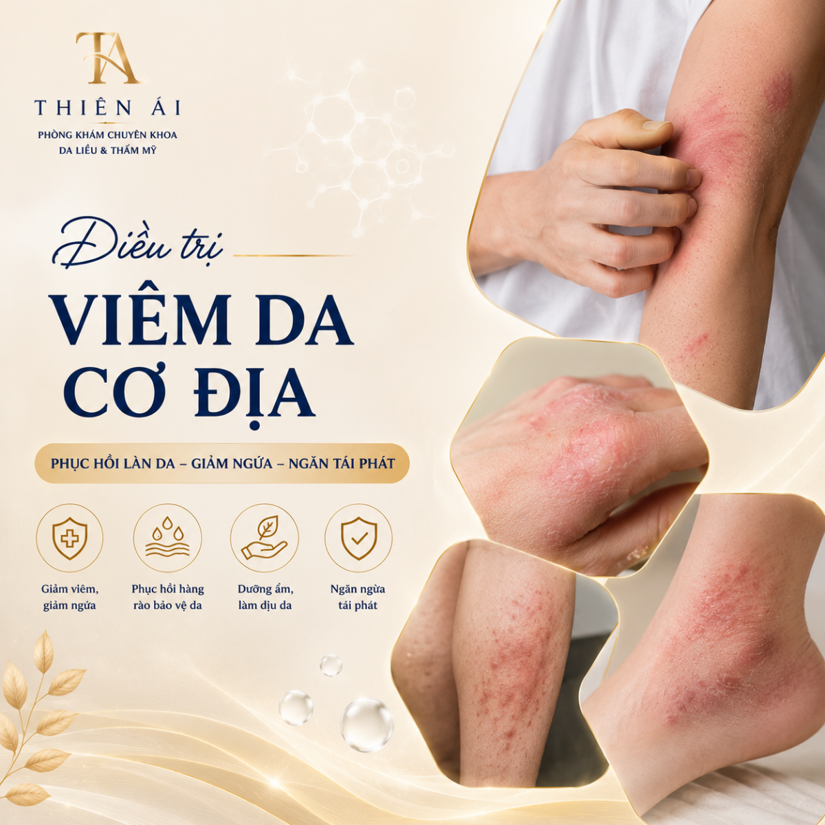 Điều trị viêm da cơ địa để kiểm soát bệnh lâu dài