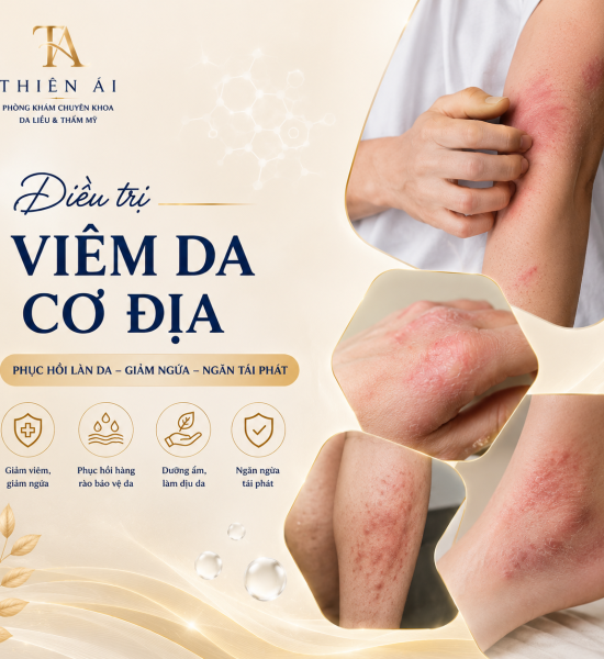 Điều trị viêm da cơ địa để kiểm soát bệnh lâu dài