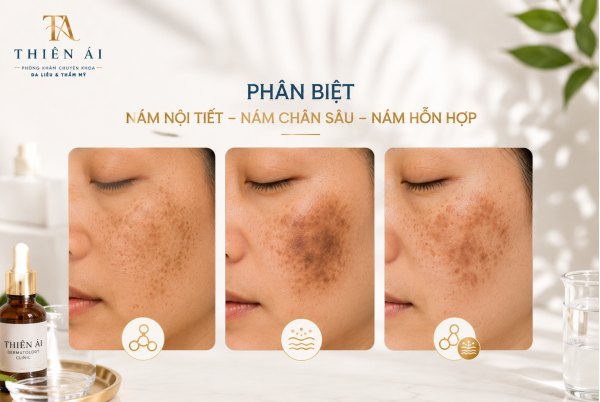 Phân biệt nám nội tiết, nám chân sâu và nám hỗn hợp