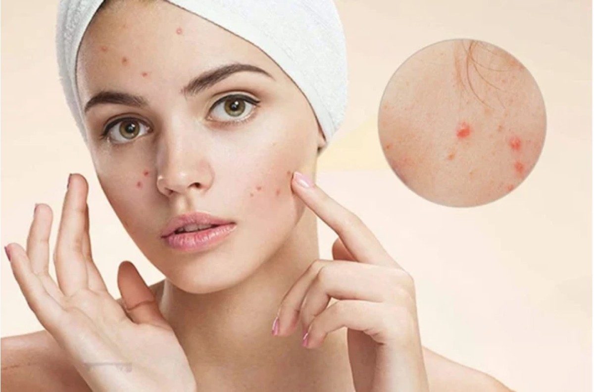 Điều trị mụn trứng cá cùng BS.CKII Diệu My: Hiểu đúng để hạn chế tái phát