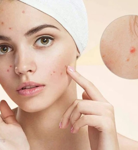Điều trị mụn trứng cá cùng BS.CKII Diệu My: Hiểu đúng để hạn chế tái phát