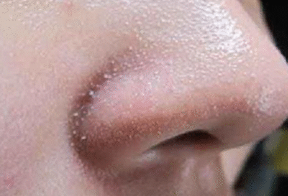 Viêm Da Tiết Bã – Nguyên Nhân Và Điều Trị Đúng Cách