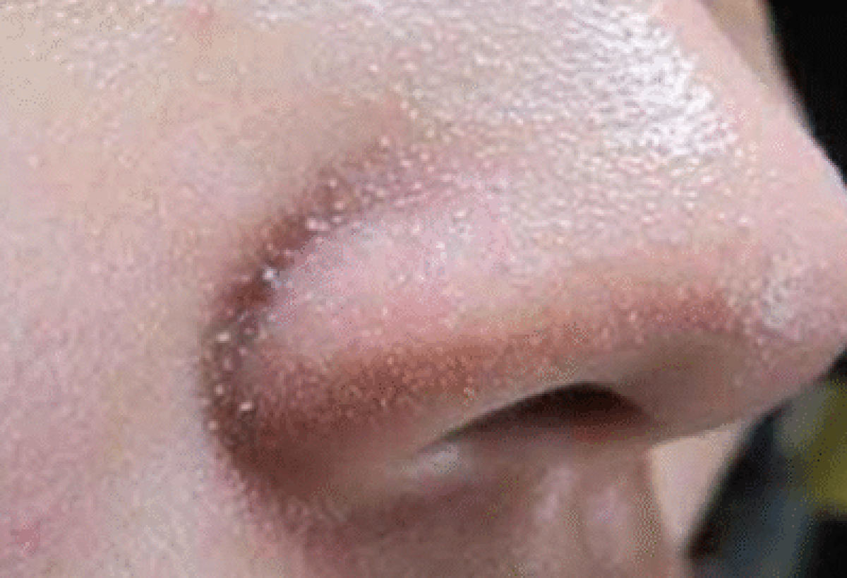 Viêm Da Tiết Bã – Nguyên Nhân Và Điều Trị Đúng Cách