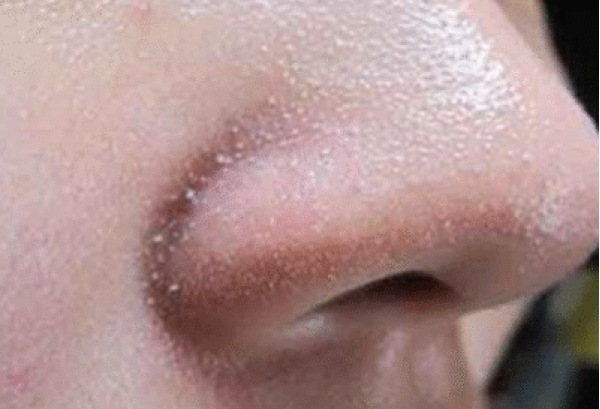 Viêm Da Tiết Bã – Nguyên Nhân Và Điều Trị Đúng Cách Viêm Da Tiết Bã – Nguyên Nhân Và Điều Trị Đúng Cách