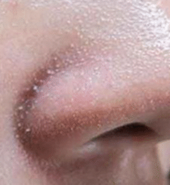 Viêm Da Tiết Bã – Nguyên Nhân Và Điều Trị Đúng Cách