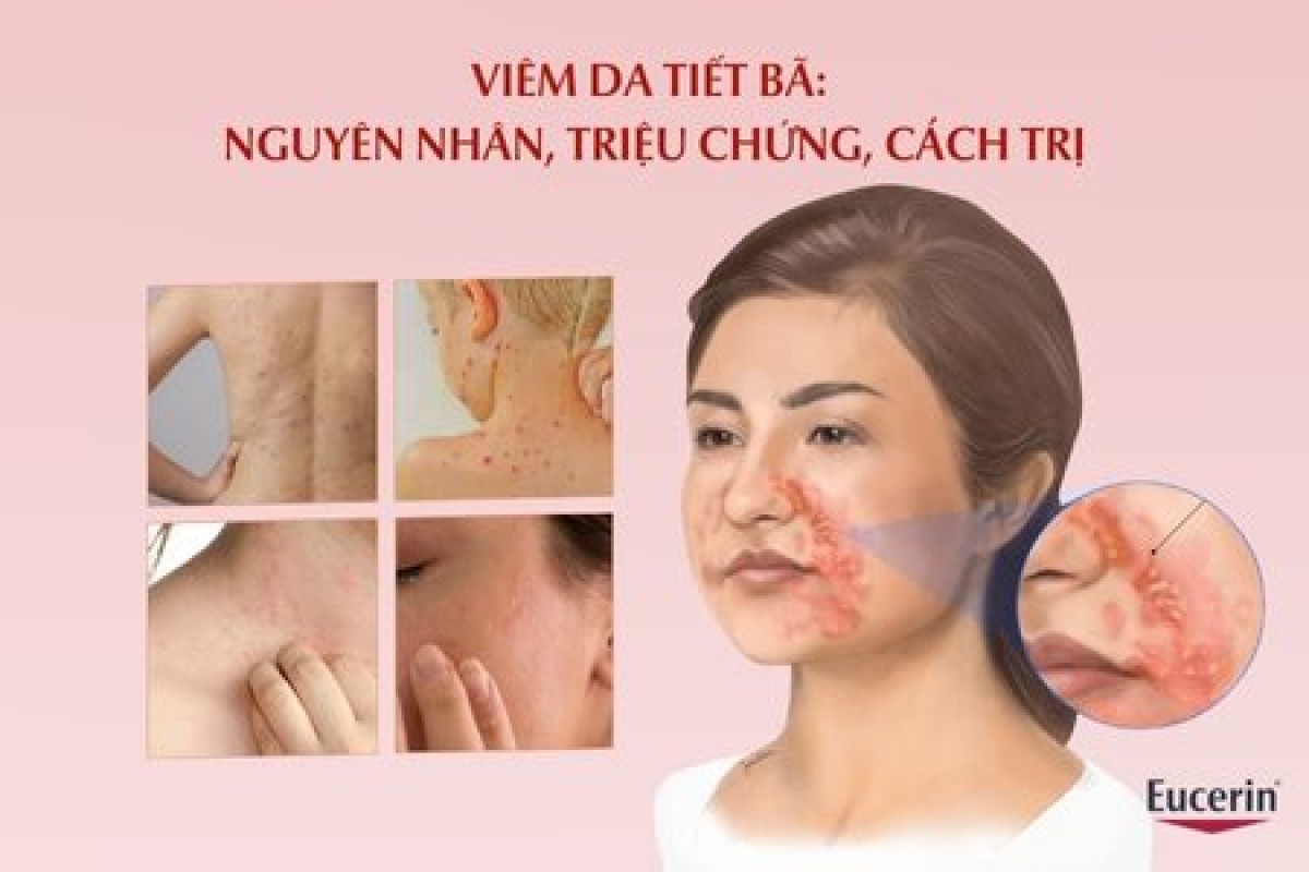 Viêm da tiết bã không thể chữa khỏi?