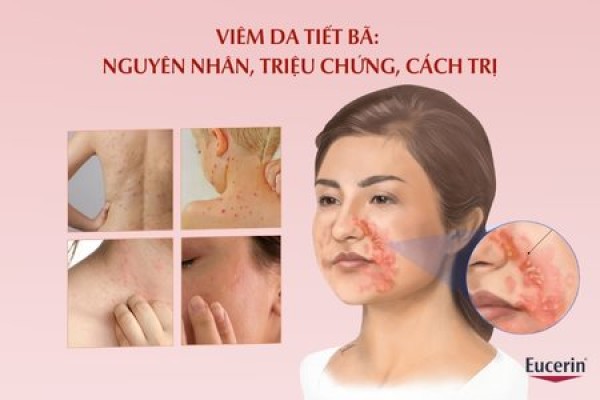 Viêm da tiết bã không thể chữa khỏi?