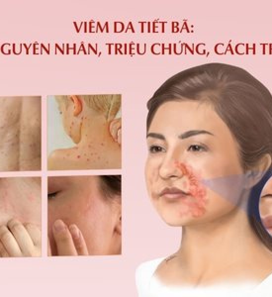 Viêm da tiết bã không thể chữa khỏi?