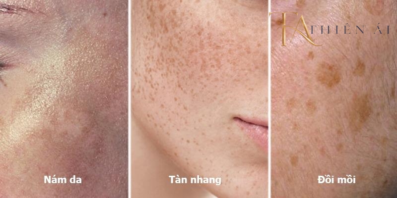 Điều trị tàn nhang và đồi mồi bằng Laser